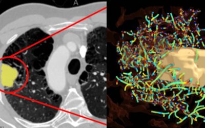 Tumor Vasculature has Long Been a Target. Measuring it is the Next Step