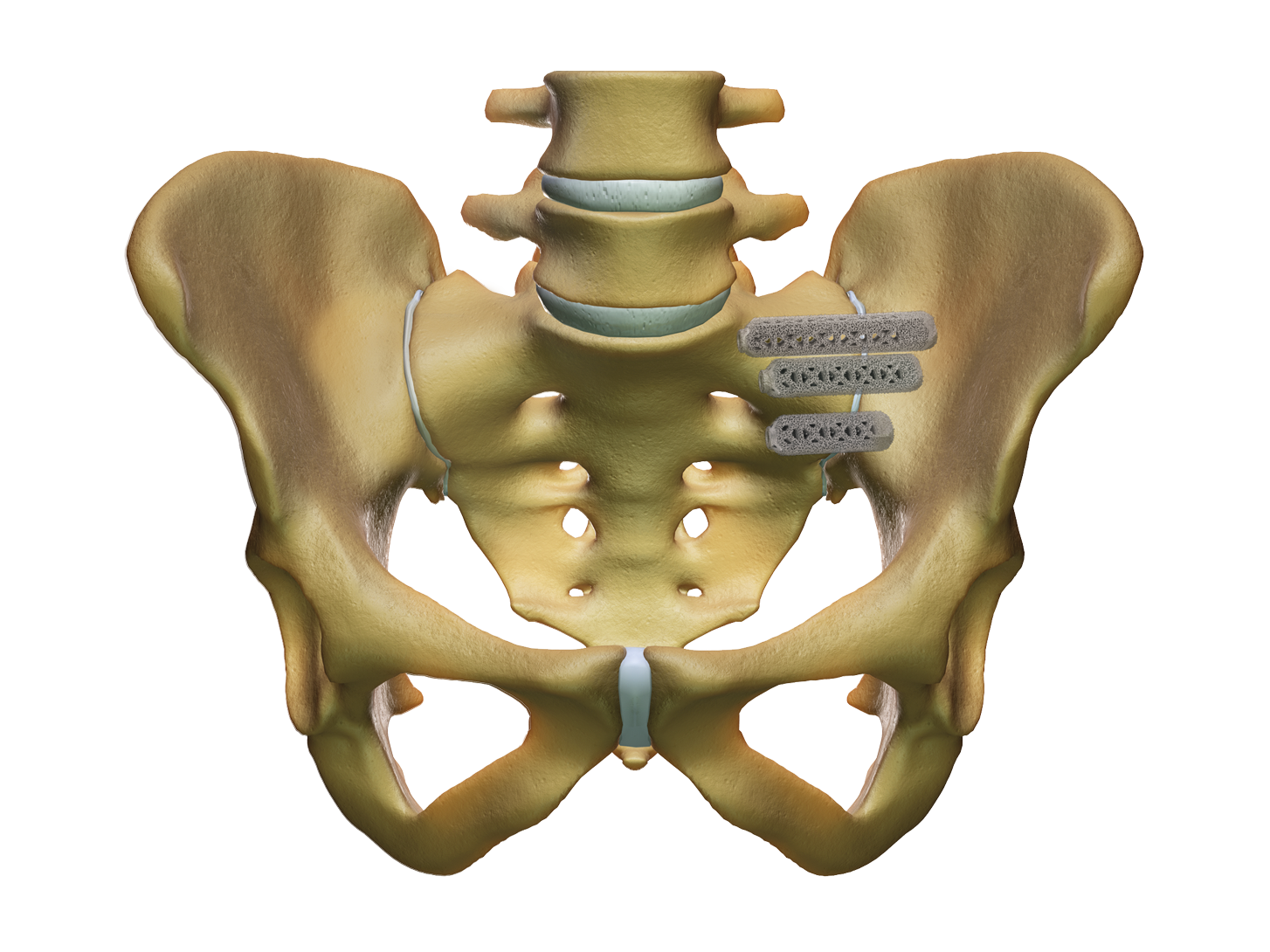 Pelvis Close Up with iFuse-3D Implants