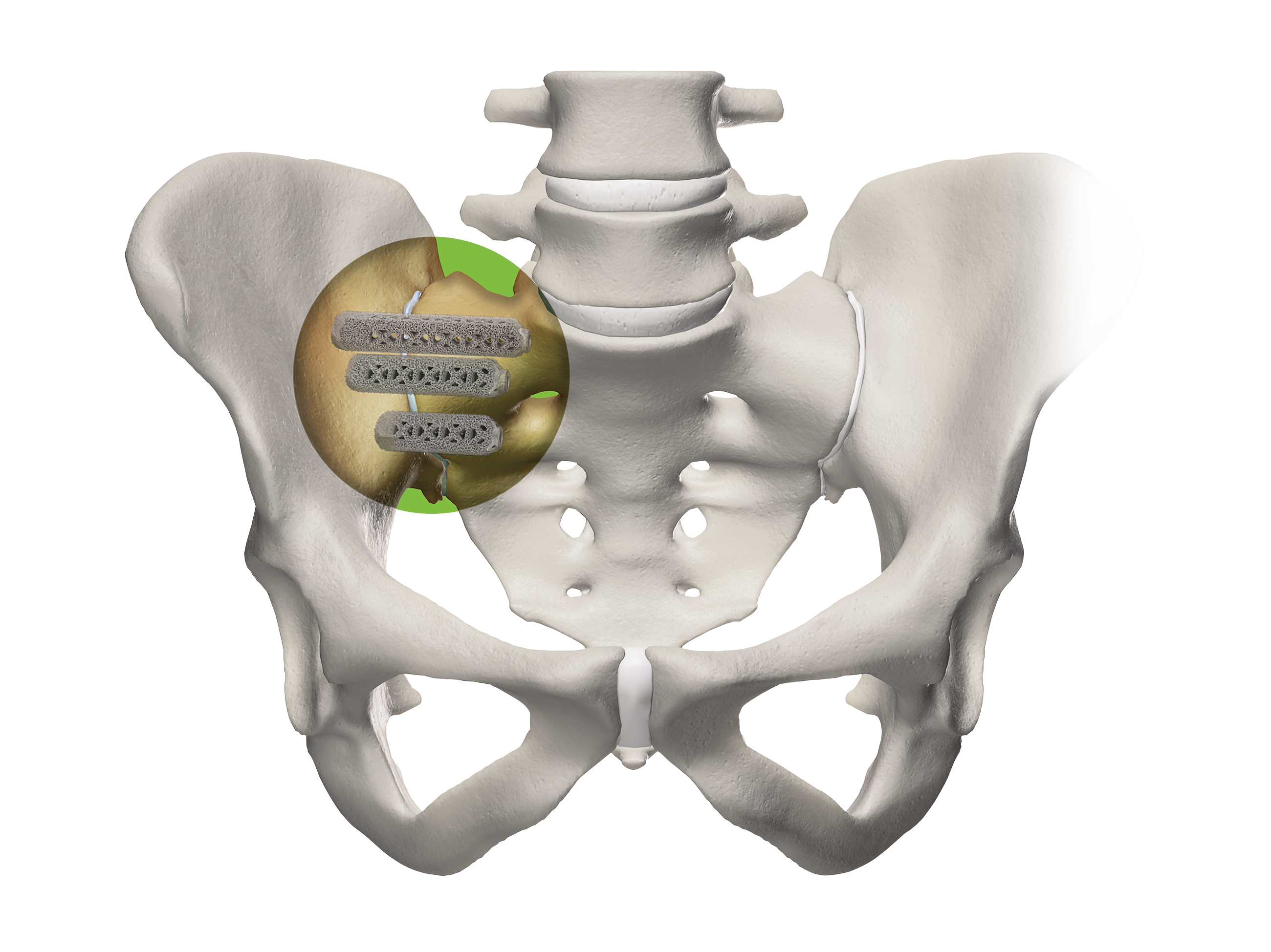 Pelvis closeup with iFuse-3D Implants