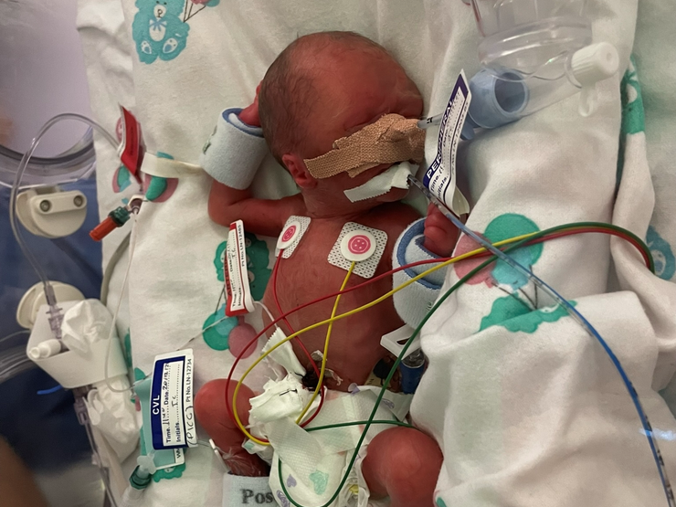 Leaine's baby Zara Grace in NICU, with wires attached to her