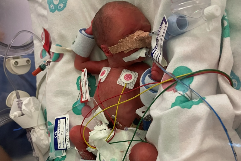 Leaine's baby Zara Grace in NICU, with wires attached to her