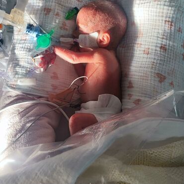 Baby in hospital attached to tubes
