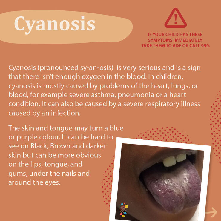Information and phots about the symptoms of cyanosis with a warning to seek immediate medical attention if these symptoms are found. These inlude skin and tongue turning blue which can be more eaily seen on people woth darker skin on the lips, tongue, gums, underthe  nails and around the eyes.