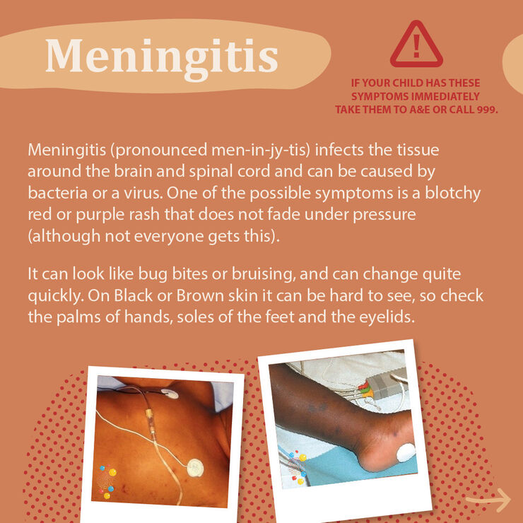 Information and photos about the symptoms of meningitis. The main symptom of meningitis is blothcy red or purple rash that does not fade under pressure. It can be harder to spot on darker skin and more easily seen round the palm of the hands, soles of the feet and eyelids.
