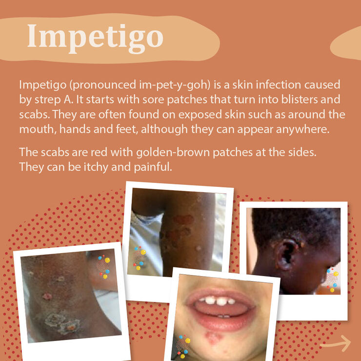Information and photos about the symptoms of impetigo. These include sore patches on the skin that turn into blisters and scabs which are often found around the mouth, hands and feet but can appear anywhere. The scabs are  usually red with golden-brown patches at the sides and can be itchy and painful.