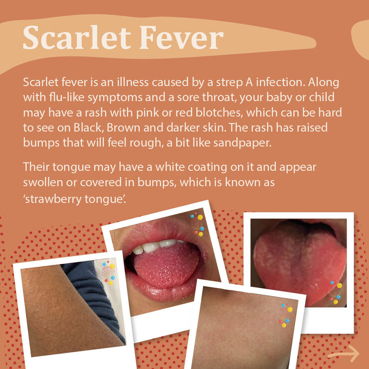 Information and photos about the symptoms of scarlet fever. Along with flu-like symptoms and a sore throat, a rash may appear with red blothces which can be harder to see on darker skin. The rash has raised bumps that will feel rough like sand papers. Their tongue may have a white coating on it and appear swollen or covered in bumps, which is known as 'strawberry tongue'.