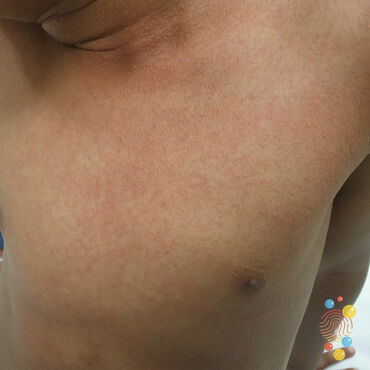 A bumpy rash on the chest of a child with Black, Brown or darker skin.