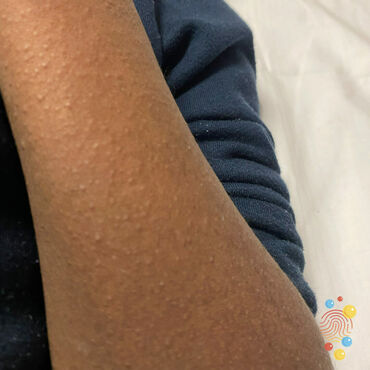 A bumpy rash on the arm of a child with Black, Brown or darker skin.