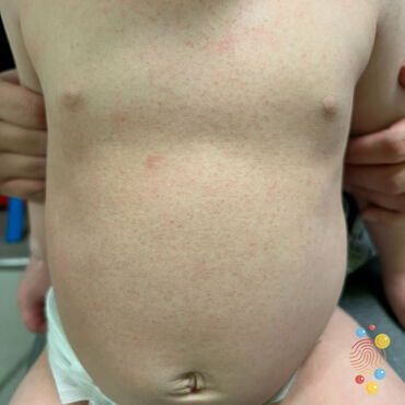 A red rash on the stomach and chest a child with White or paler skin.
