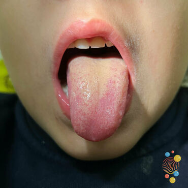 A child with lighter skin shows their tongue with a white coating on it.