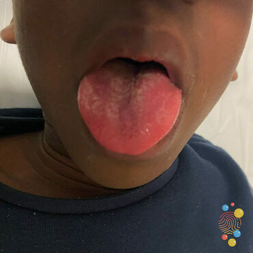A child with darker skin shows their tongue with a red 'starberry tongue' rash on it.