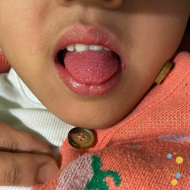 A child with darker skin shows their tongue covered in bumps.
