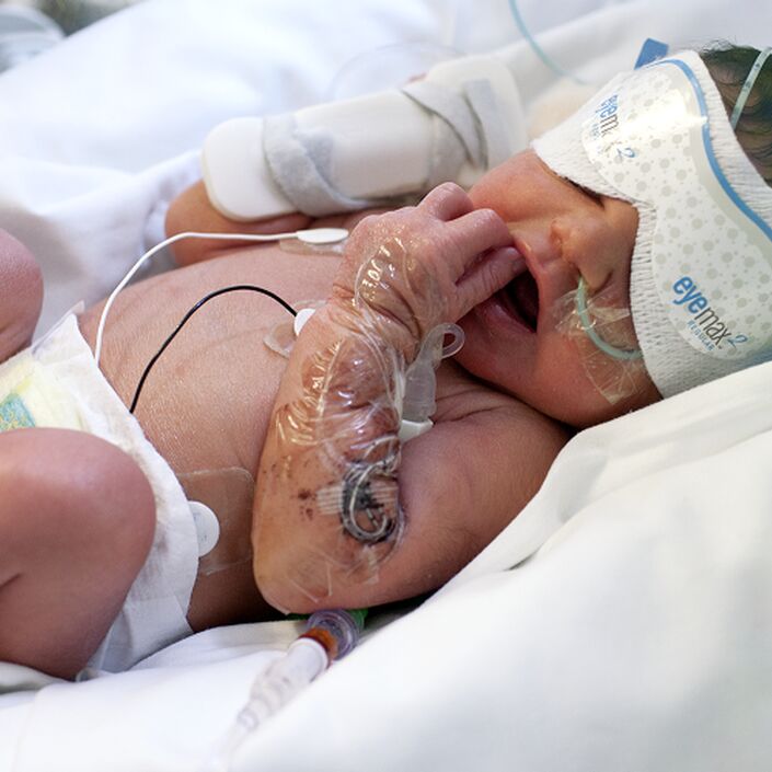 Baby in hospital bed wearing protective eye coverings with monitors attached to its chest.