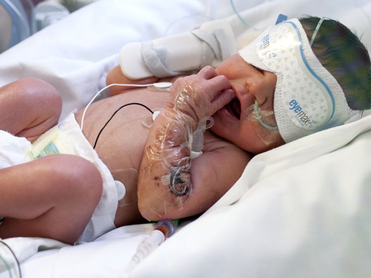 Baby in hospital bed wearing protective eye coverings with monitors attached to its chest.