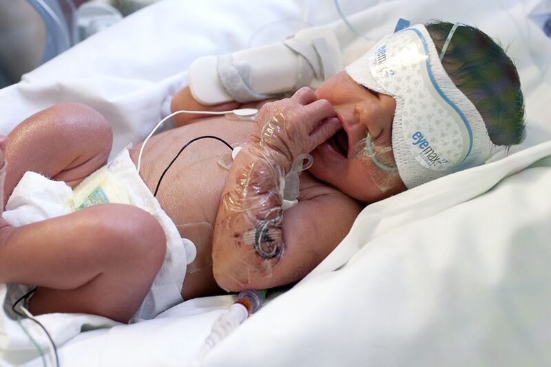 Baby in hospital bed wearing protective eye coverings with monitors attached to its chest.